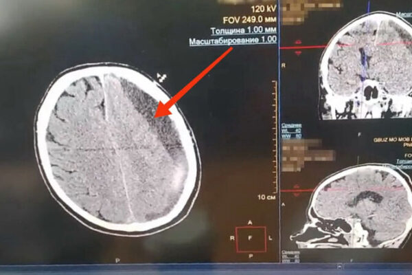 «После операции мозг встал на место» — удалив огромную гематому, врачи спасли жизнь пациенту